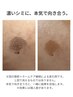 【濃いシミに】集中ケア初回体験60分　13,200円→4,400円
