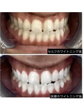 シエル(CIEL)/医療提携セルフホワイトニング