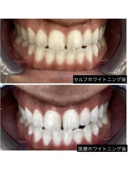 シエル(CIEL)/医療提携セルフホワイトニング
