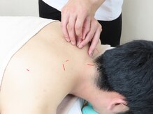 亀有ゆうろーど鍼灸整骨院/鍼