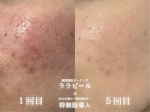 リル 和歌山市店(lilou)の雰囲気(繰り返す赤みに。ララピール+幹細胞導入!)