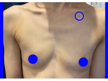 セブンシーズ 上野店(Seven Seas)/葉月式バストアップ《施術前》