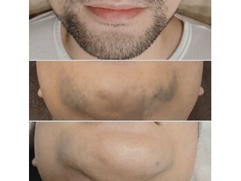 いやされサロン フー(fuu+)/お得なヒゲ脱毛♪¥2980～