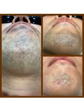 リアンジュ/ヒゲ脱毛の経過