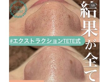 毛穴屋/毛穴洗浄毛穴エクストラクション