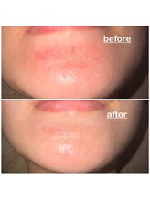 ミニョン(mignon)/急な出来物にも対処を！