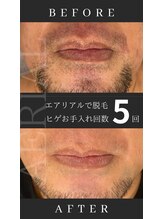 エアリアル 南行橋店/結果重視のメンズヒゲ脱毛