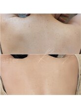 リバージュ(Riverge)/肌改善(背中/2ヶ月)