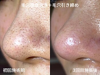 ミントの写真/小鼻のキワまで妥協しない！諦めた黒ずみをすっきりオフ！本格毛穴エクストラクションでなめらかつるん肌へ