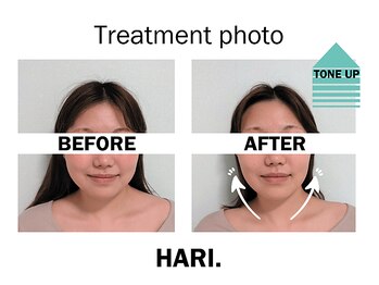 ハリドット 天王寺院(HARI.)/美顔鍼+フェイシャル10代