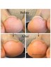 【フット/ケア】巻き爪ケアコース●当日ご相談でメニューを決めたい方