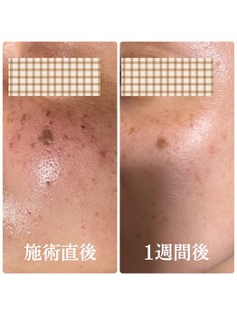 サロンデュヒャーク 志木駅前店(salon du ひゃーく)/光フェイシャル♪