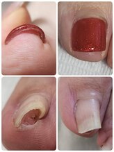 プリティア クリアモエ(Pritia clear moe)/【巻き爪でお悩みの方】