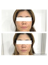 エイミー(Aimee)/【小顔コース】ビフォーアフター