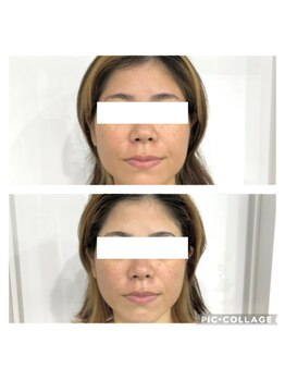 エイミー(Aimee)/【小顔コース】ビフォーアフター