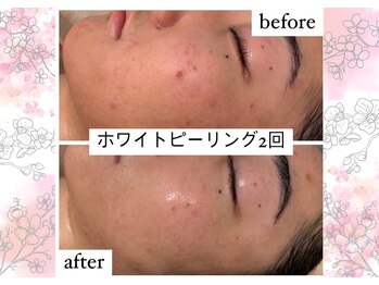 アリュメント(Allument)/【BA】ホワイトハーブピーリング