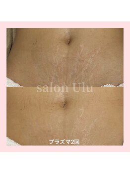 ウル(Ulu)/肌改善！コラーゲン生成