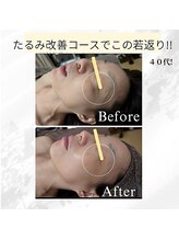 ミヤビ(MIYABI)/1回の施術効果