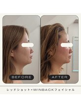 さかうえ接骨院/レッドショット×WINBACK