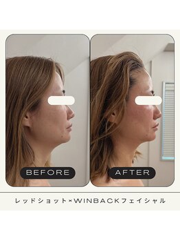 さかうえ接骨院/レッドショット×WINBACK
