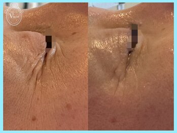 ヴィオール 名古屋栄店(VIOR)/美白効果大!ふっくらハリ肌へ!