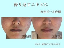 プレリー 自由が丘店/水光ピールスキン