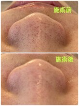 マナ(mana)/【黒ずみ解消】30分でツヤ肌へ