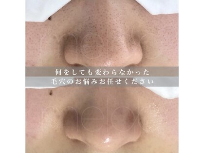 黒ずみ毛穴ケア専門店　melab　【ミラボ】〈毛穴エクストラクション/毛穴ケア〉の写真