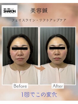 トゥーアズ シャロン(toAZ SHARON)/美容鍼フェイスラインケア