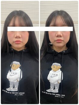 長寿鍼灸院 長寿整骨院/美容鍼25本の効果★小顔効果