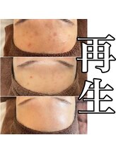 サロンツキ(salon tuki)/頑固な跡/症例