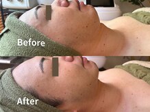 シゼン 恵比寿店(S1ZEN+)/小顔マシン1回