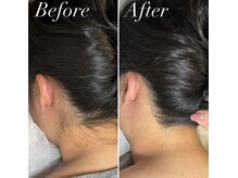 インベスト(INVEST)/うなじ脱毛