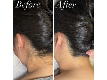 インベスト(INVEST)/うなじ脱毛