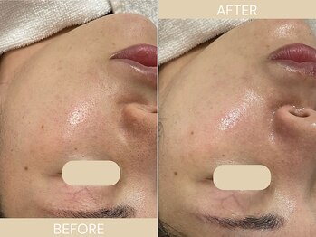 エクラ(eclat)/施術回数:1回