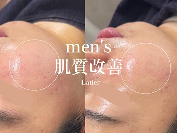 ラティエ(Latier)/ハーブピーリングで毛穴ケア♪