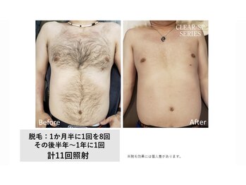 グランデ(Grande)/メンズ光脱毛効果◎