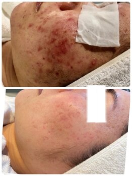 プランス 福岡(PLANCE)/毛穴/肌質改善エステ福岡天神