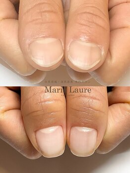 マリーロール 梅田店(Marie Laure)/自爪育成/深爪矯正/ネイルケア