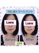 ルアナ(Luana)/BBL光トリートメント