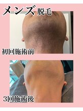 メゾン ミニョンヌ(maison mignonne)/メンズ脱毛☆