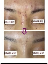 ジナ ビューティ(GINA BEAUTY)/幹細胞入りハーブピリング