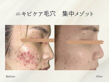 ホリスティックサロン ヘルバ(Holistic salon Herba)/跡ニキビ毛穴ケア　施術変化