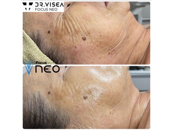 エイプリル/【蓄熱式超音波】比較写真