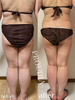 プラウディア(PROUDIA)/痩せる専門/痩身/ダイエット