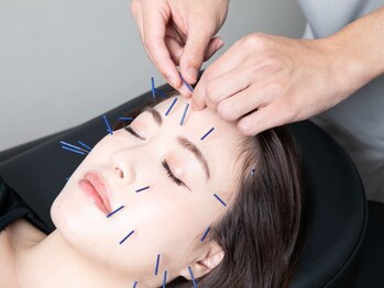 h&h八王子のパーソナル鍼灸整骨院・整体院の写真/顔のバランス、肌質、筋肉の状態、すべてに働きかける美容鍼で理想の自分に一歩近づいてみませんか？