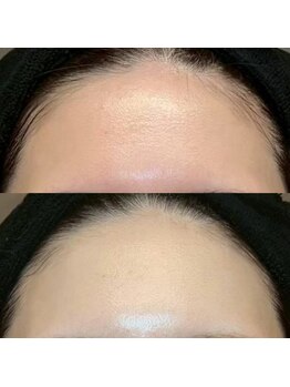 エラ(ella)/30代シワ・美白