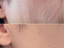 【ハーブピーリング専門店・毛穴・ニキビケア】Herbal Salon BLANC名古屋高岳の雰囲気(5day美肌根本改善コース【ハーブピーリング/毛穴ケア/ニキビ】)