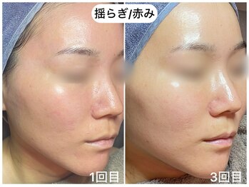 フラックス 京都(FLUX)/【エンビロン】揺らぎ肌コース