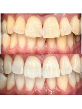 シエル(CIEL)/医療提携セルフホワイトニング